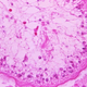 Una microfotografía de una muestra de tejido cerebral humano infectada con quistes larvarios de la tenia del cerdo (Taenia solidum)